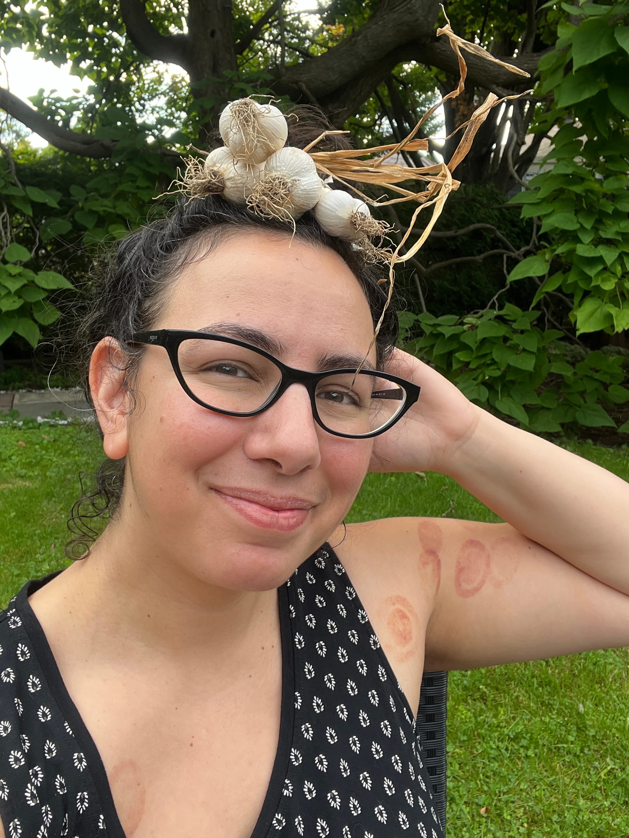 Selfie in which I'm wearing a garlic wreath on my head like a crown while smiling close-lipped and serene at the camera. There are circular suction marks on my arms and chest from therapeutic cupping. 